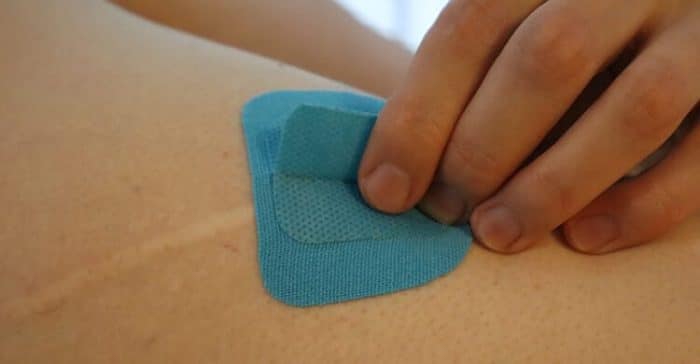 Lähikuva kahvateipistä, jolla venytetään arpikohtaa ihossa
